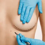 Breast_lift_maxtopexy_fba